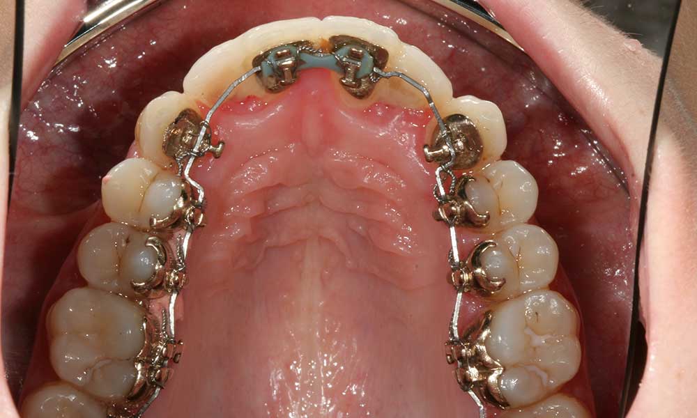 Zahnimplantate - Lingualtechnik