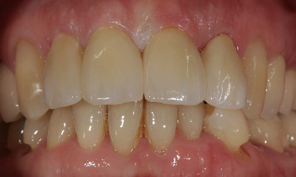 All-ceramic crowns - after