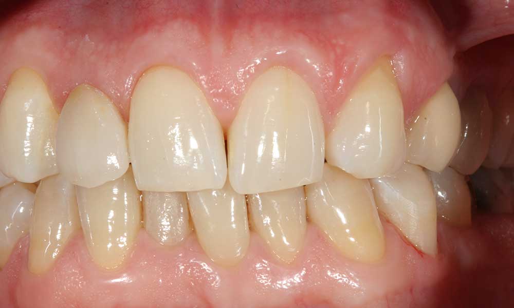 All-ceramic crowns - after